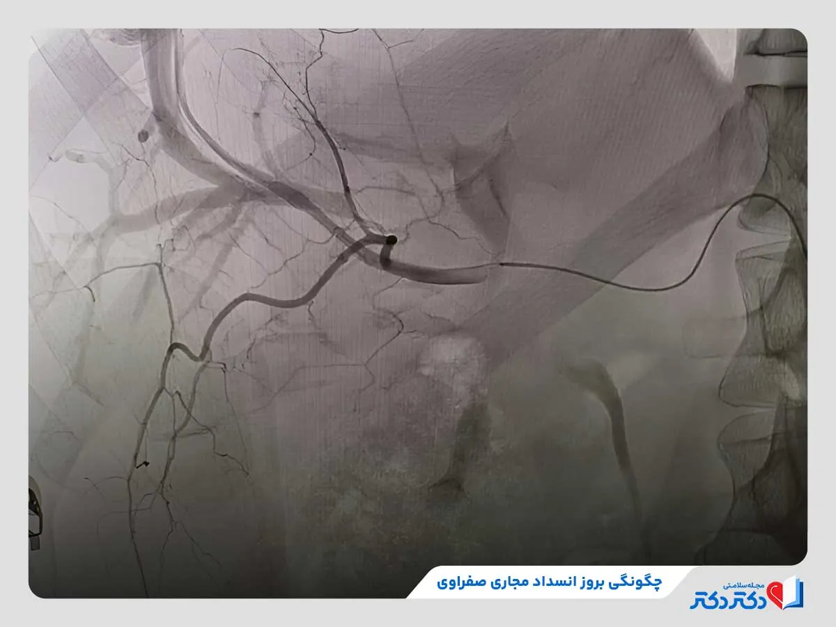 بررسی چگونگی وقوع انسداد مجاری صفراوی