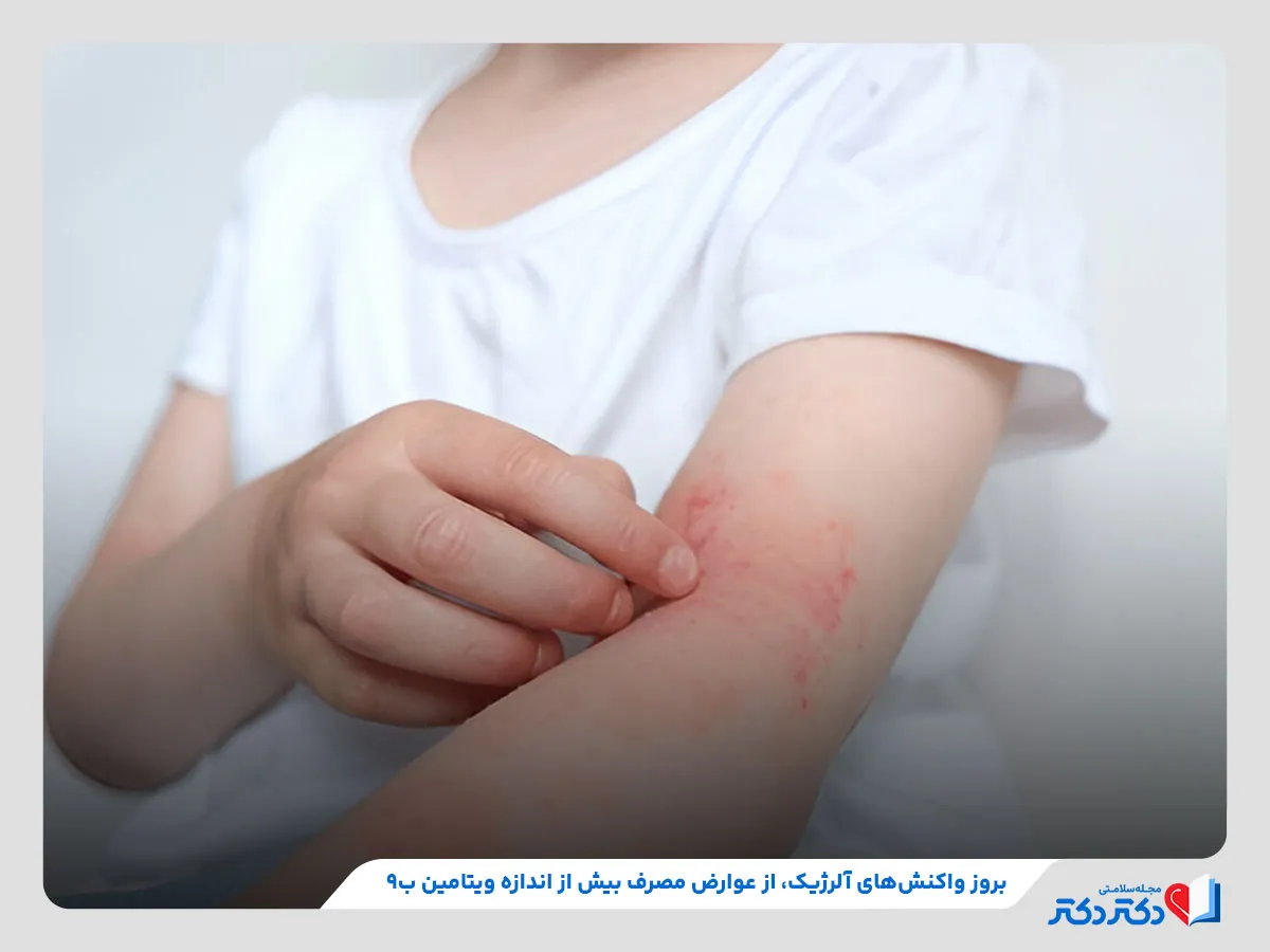 احتمال بروز حساسیت پوستی در صورت مصرف زیاد ویتامین ب۹