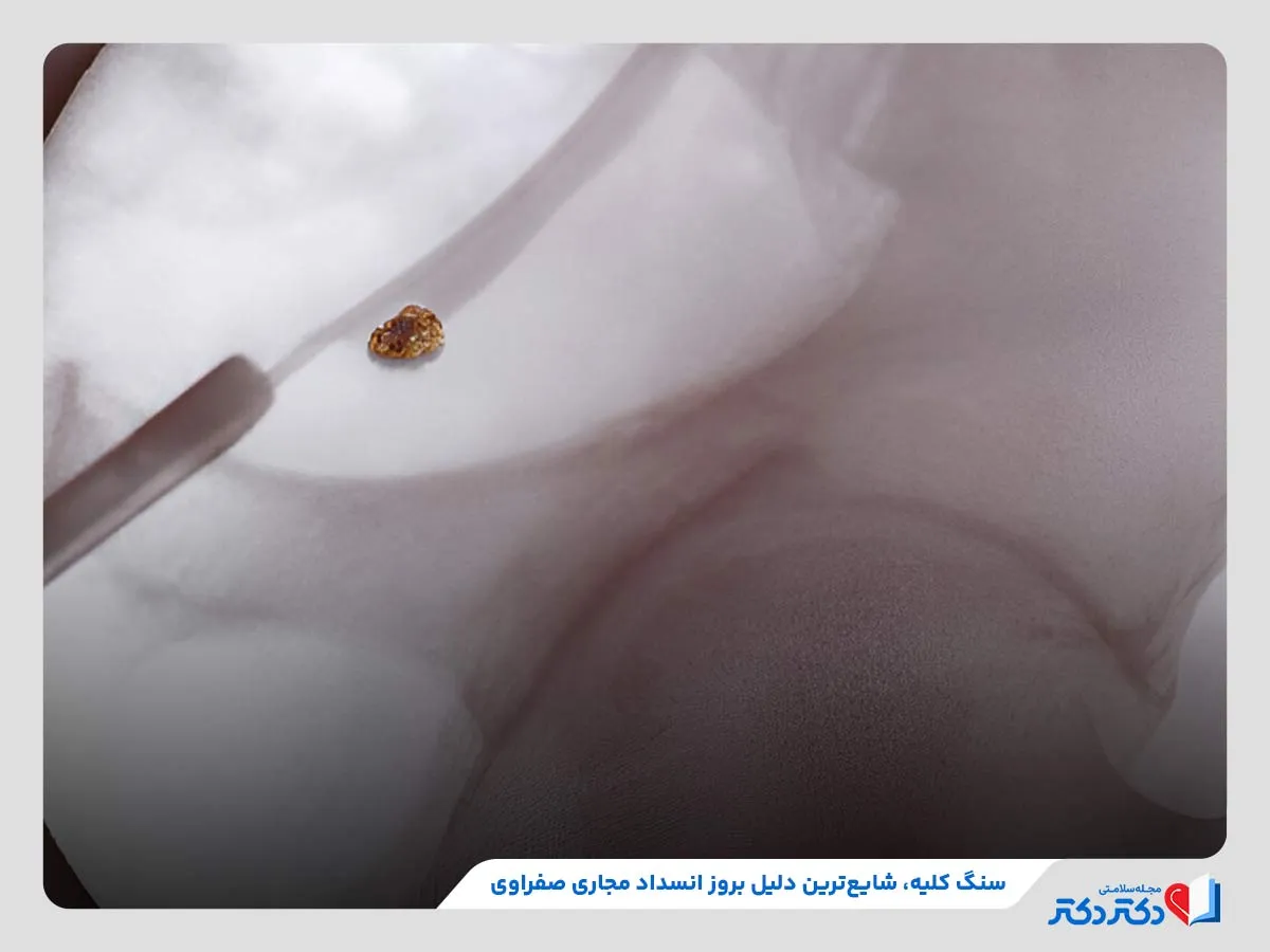 بررسی دلایل بروز انسداد مجاری صفراوی مانند تشکیل سنگ
