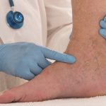 لخته شدن خون در پا؛ علل، خطرات و نحوه درمان