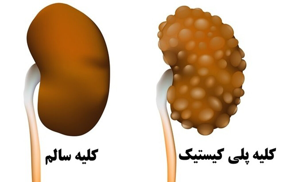 درد کلیه ی سمت راست