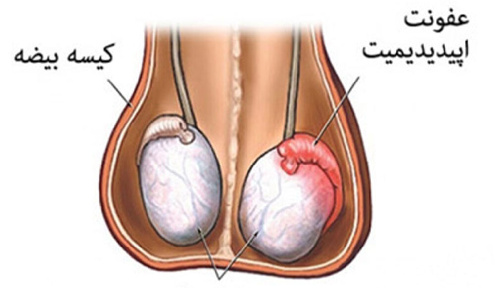 عکس و فیلم کیست بیضه