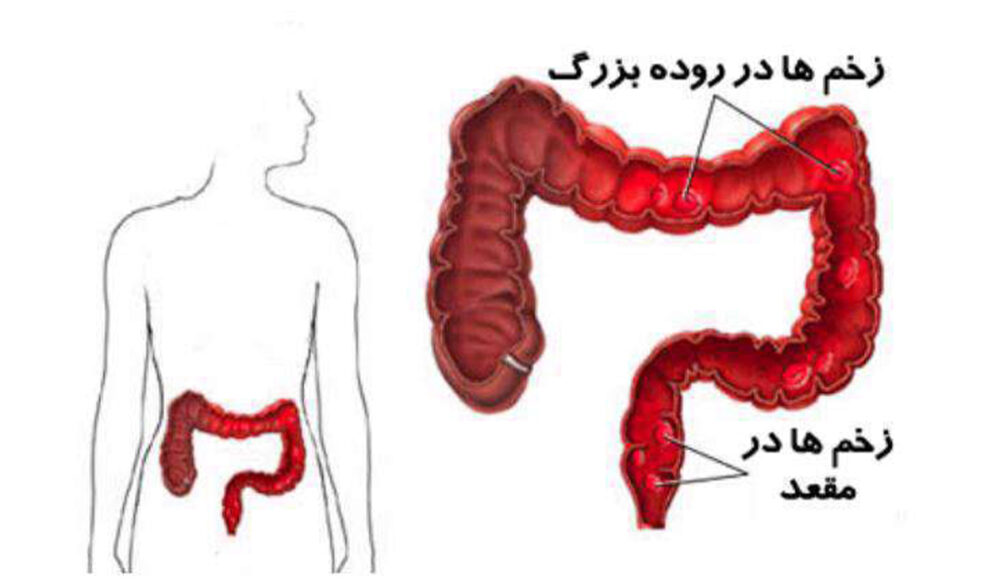 کولیت زخمی