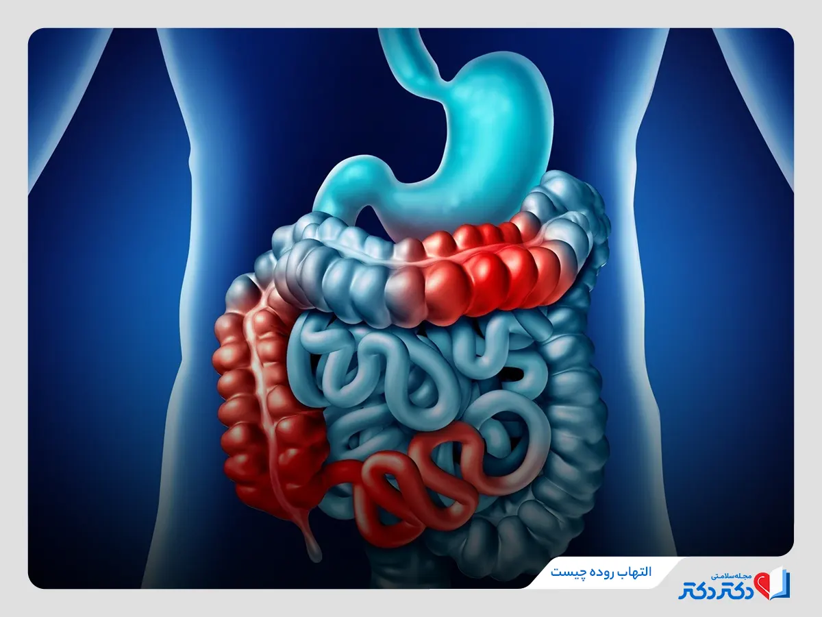 نقاطی از روده بزرگ و باریک درگیر بیماری التهاب روده 