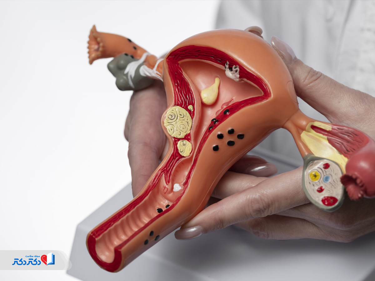 توده در واژن چیست؟ همه‌چیز درباره توده‌های واژن