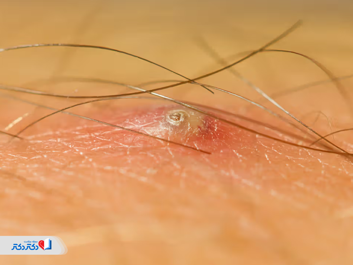 موی زائد از دلایل ظهور توده در واژن