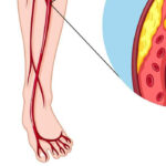روش های افزایش گردش خون در پاها