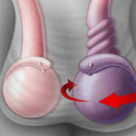 درد بیضه سمت چپ؛ مهم‌ترین دلایل و درمان