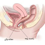 افتادگی واژن چیست؟ علائم،تشخیص و درمان پرولاپس واژن