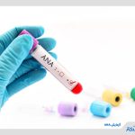 آزمایش آنتی بادی ضد هسته ای چیست و چه زمانی باید آن را انجام دهیم؟