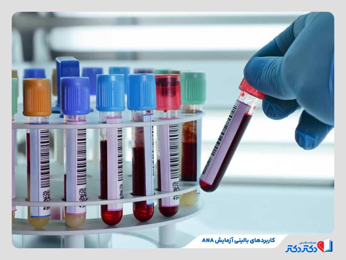 پزشک در حال آزمایش ANA برای شناسایی بیماری‌های خودایمنی