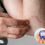 بررسی کامل علت خارش بدن در افراد دیابتی