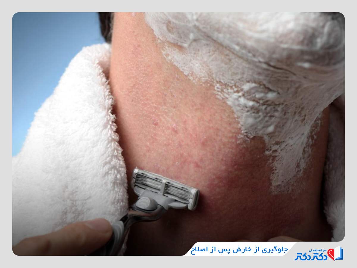 رفع خارش بعد از اصلاح