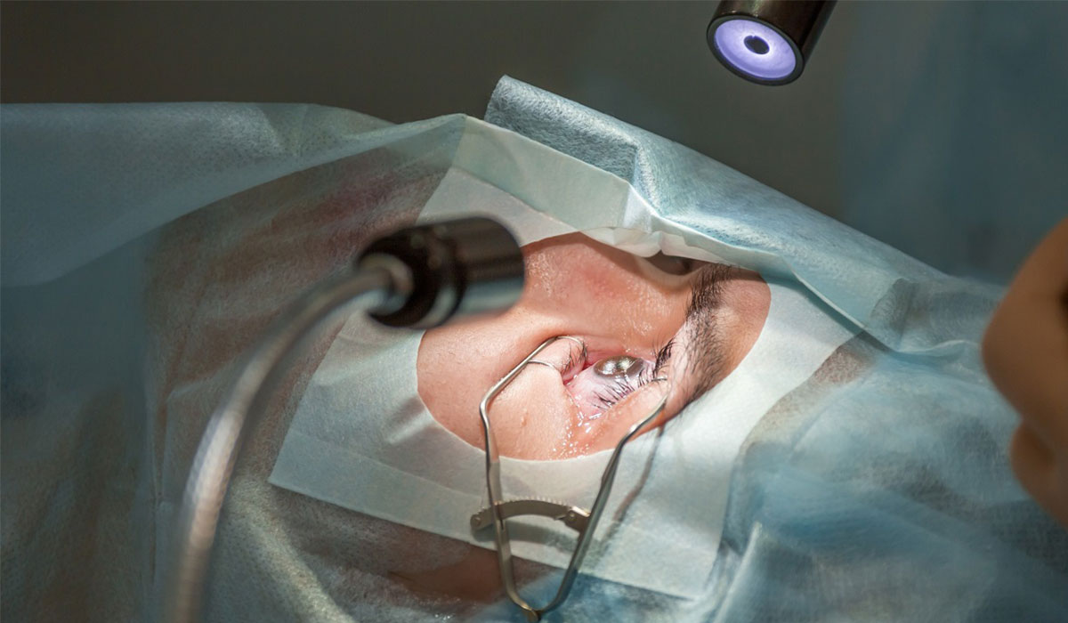 جراحی لیزیک چشم چیست؛ همه چیز درمورد عمل لیزیک