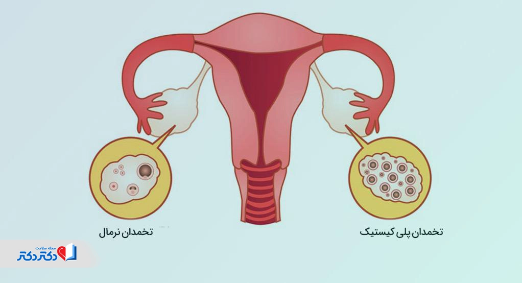 کیست تخمدان و بارداری
