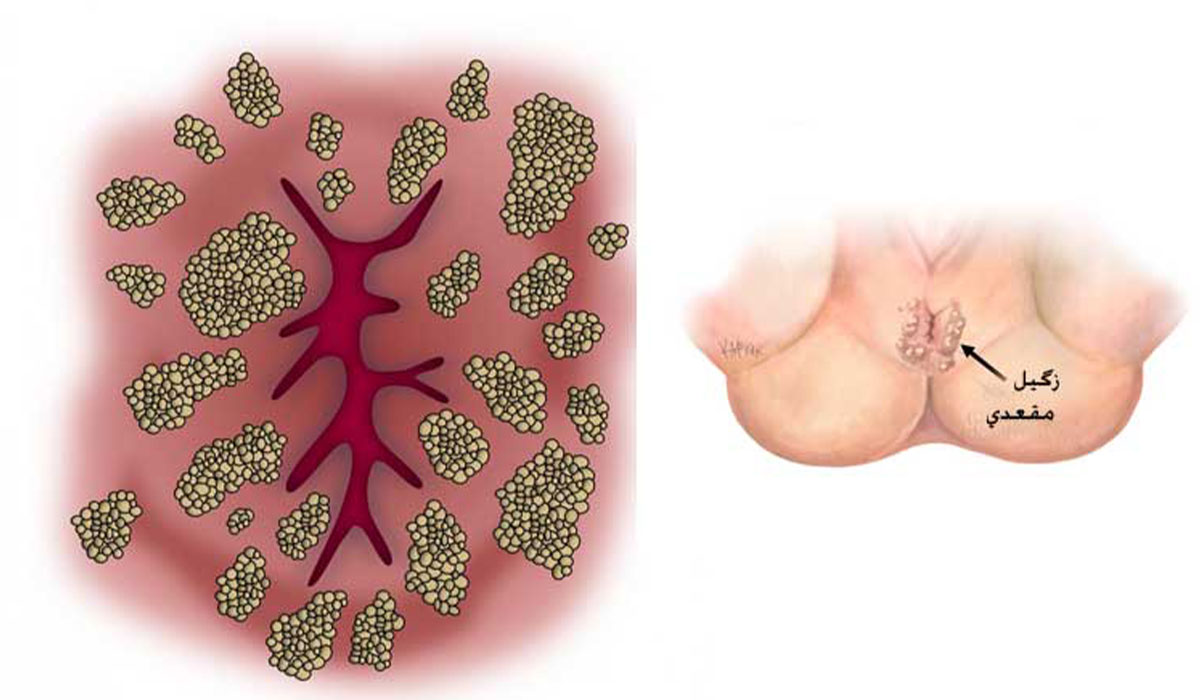 زگیل مقعدی چیست؛ علائم، علت ایجاد و راه های درمان | مجله دکتردکتر
