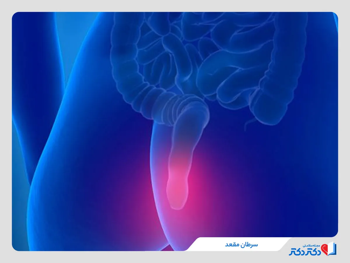 سرطان مقعد چیست بررسی علت و علائم آن