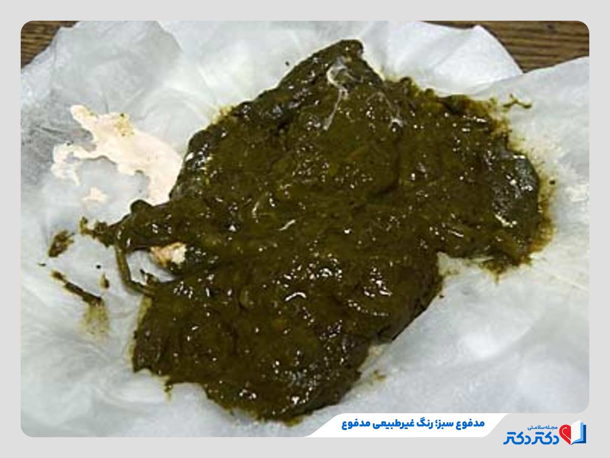 تغییر رنگ طبیعی مدفوع به رنگ سبز به دلیل خوب کار نکردن صفرا