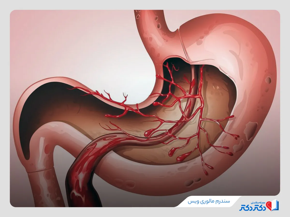 سندرم مالوری ویس و بررسی علل، علائم و عوامل خطر