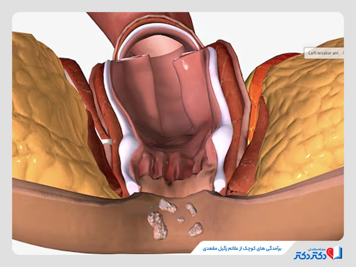 برآمدگی‌های کوچک اطراف مقعد از علائم زگیل مقعدی