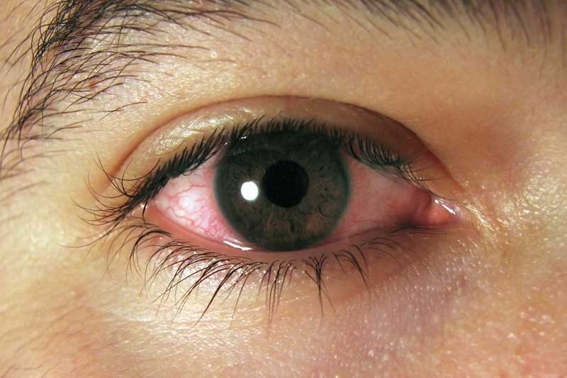 عفونت های شایع چشم و راه های درمان آنها