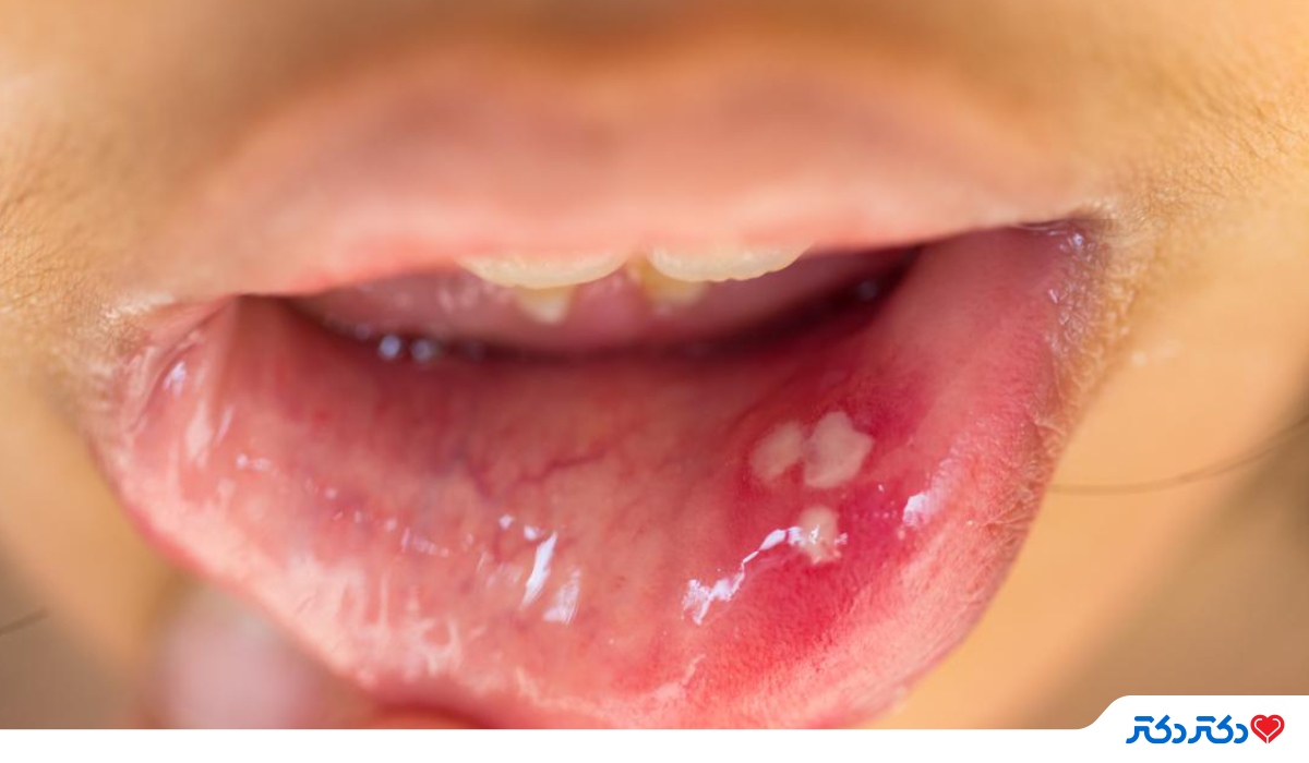 HPV دهان