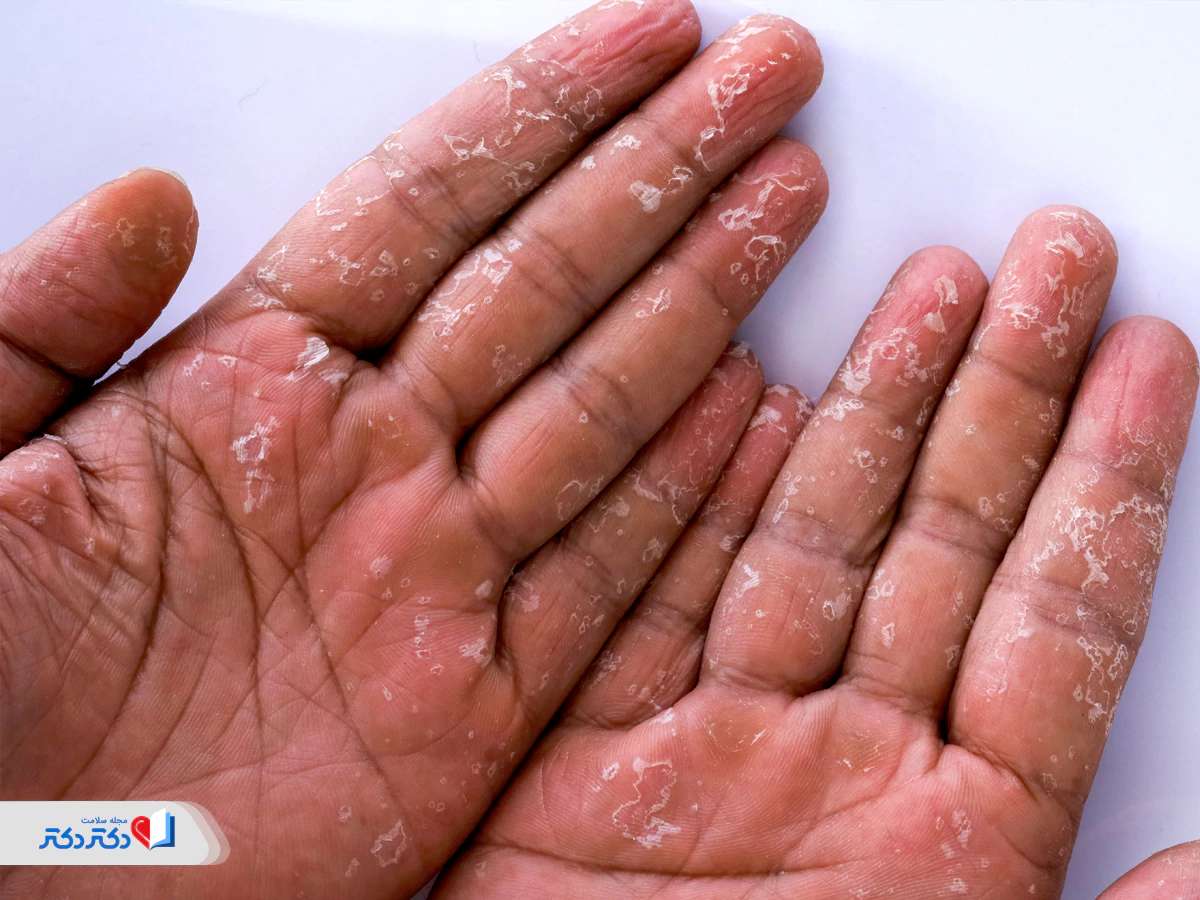 همه‌چیز درباره سندروم شوک سمی