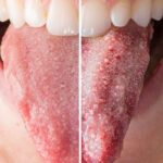 برفک دهان چیست؛ علائم، علل و راه های درمان