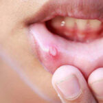 تفاوت آفت دهان و تبخال دهان چیست؛ نحوه تشخیص و درمان