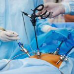 جراحی های کاهش وزن؛ انواع، خطرات و زندگی بعد از عمل