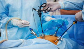 جراحی های کاهش وزن؛ انواع، خطرات و زندگی بعد از عمل