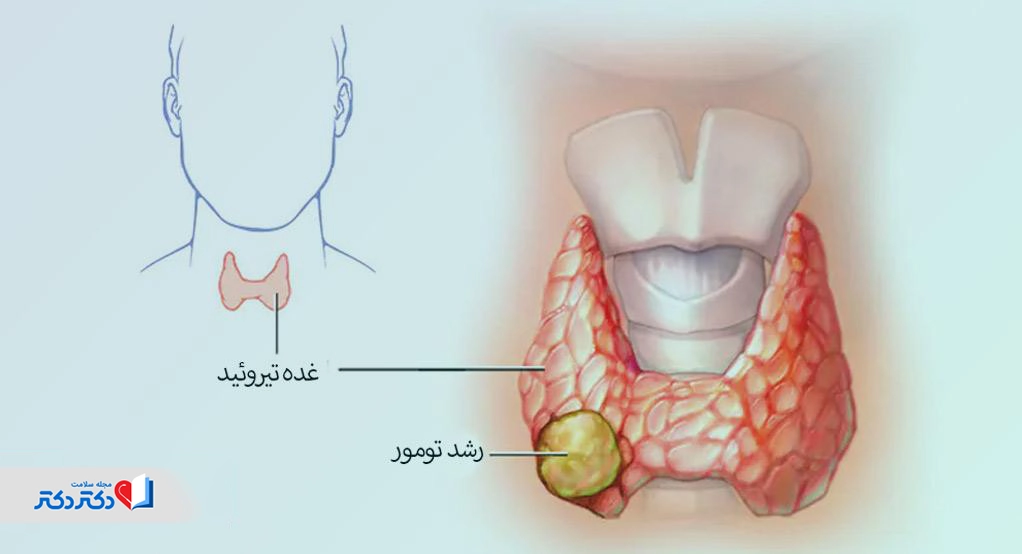 سرطان تیروئید بدخیم