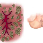 زگیل مقعدی چیست؛ علائم، علت ایجاد و راه های درمان