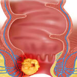 سرطان مقعد چیست؟ خطرات،علت و علائم سرطان مقعد و روش درمان