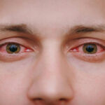 انواع عفونت های شایع چشم و راه های درمان آنها