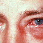 اندوفتالمیت چشم؛ علائم و علل، تشخیص و درمان
