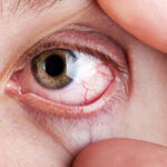 بیماری یووئیت چشم؛ انواع، علائم، علت و درمان
