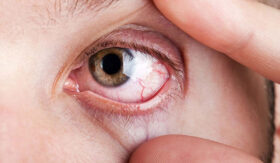 بیماری یووئیت چشم؛ انواع، علائم، علت و درمان