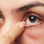 تبخال چشمی؛ انواع، علائم، علل و درمان ها