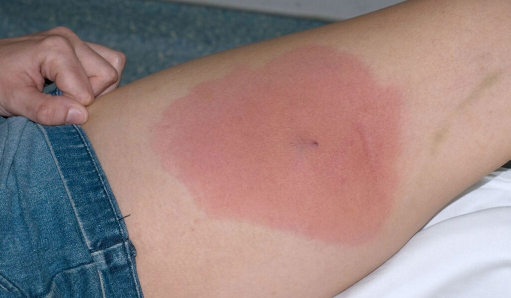 عفونت استافیلوکوکوس(mrsa)؛انواع، علائم، تشخیص و درمان