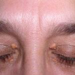 درمان و ازبین بردن چربی پلک چشم + علل و علائم