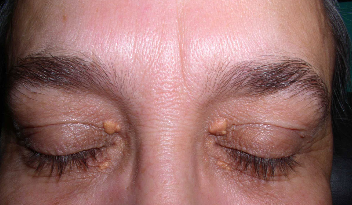 درمان و ازبین بردن چربی پلک چشم + علل و علائم