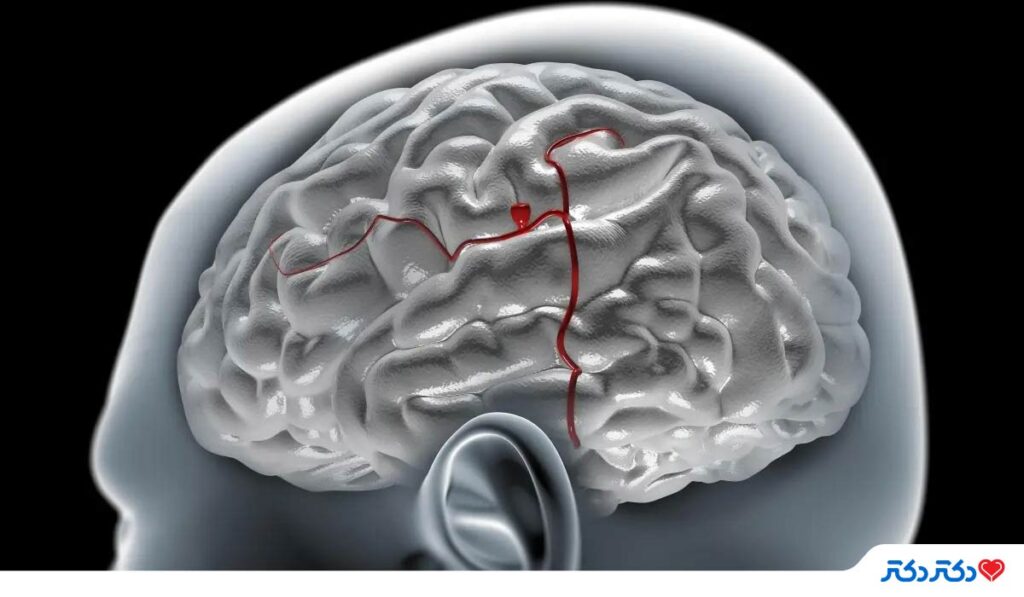 سردرد ناشی از آنوریسم مغزی