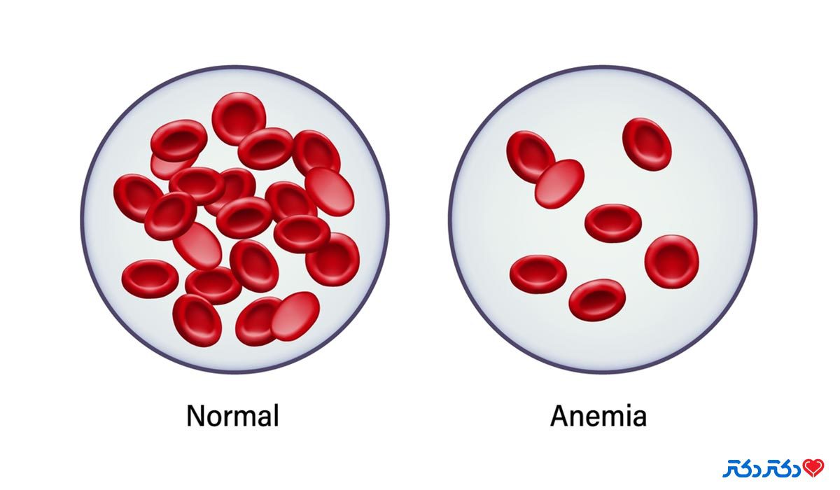 آیا کرونا باعث کاهش پلاکت خون می‌شود؟