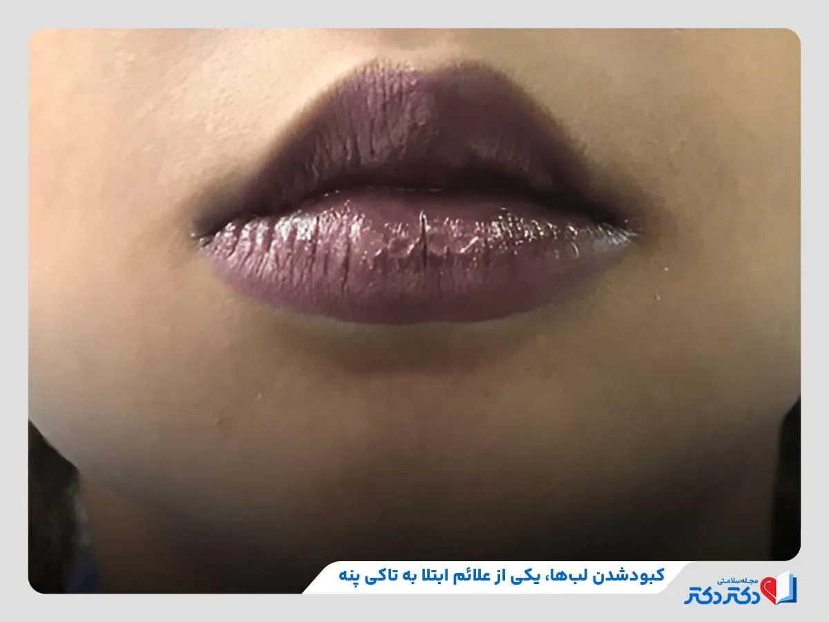 بررسی علامت‌‌ها و نشانه‌های بیماری تاکی پنه