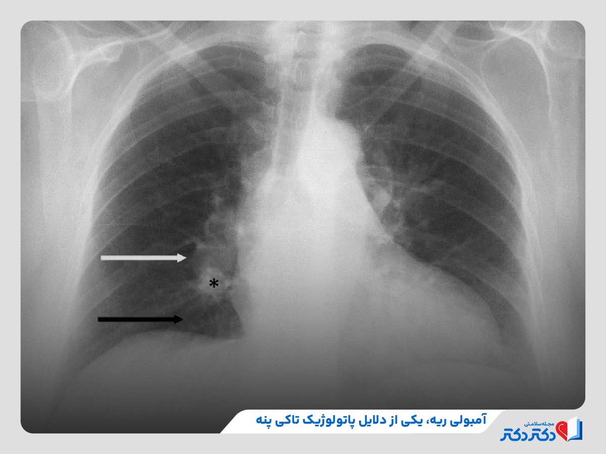 ابتلا به بیماری تاکی پنه به دلیل آمبولی ریه