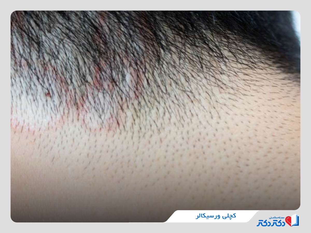 Pityriasis Versicolor
