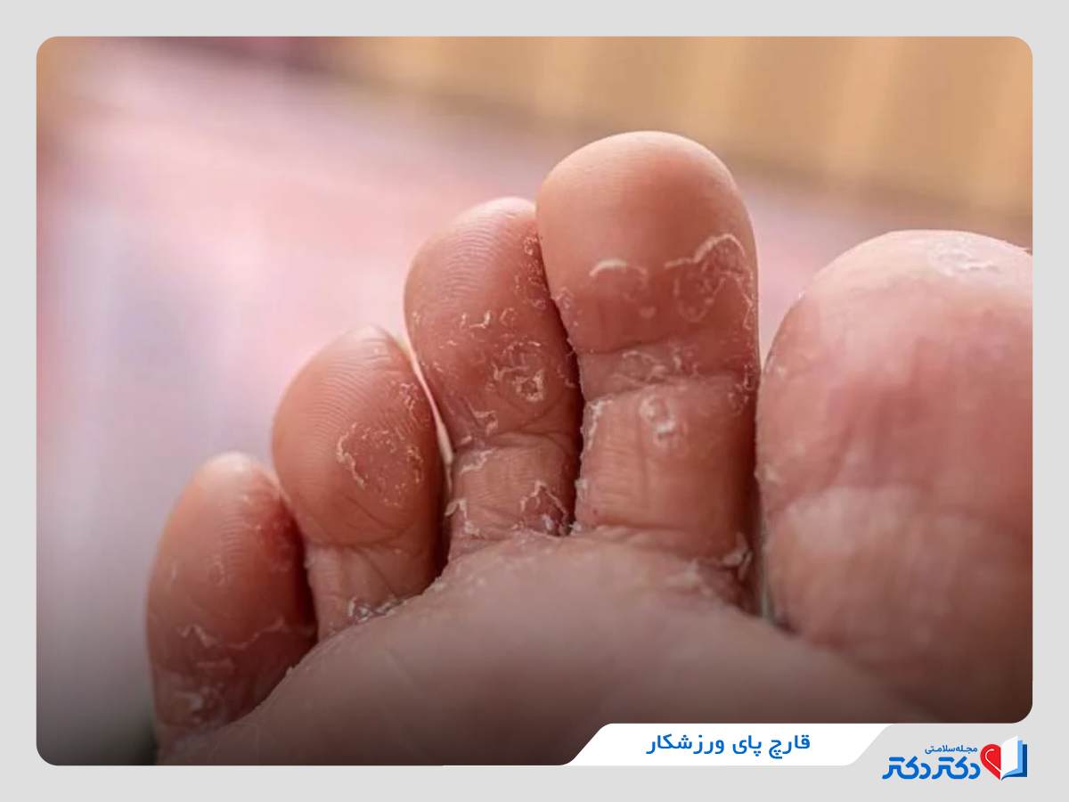 قارچ از نوع پای ورزشکار