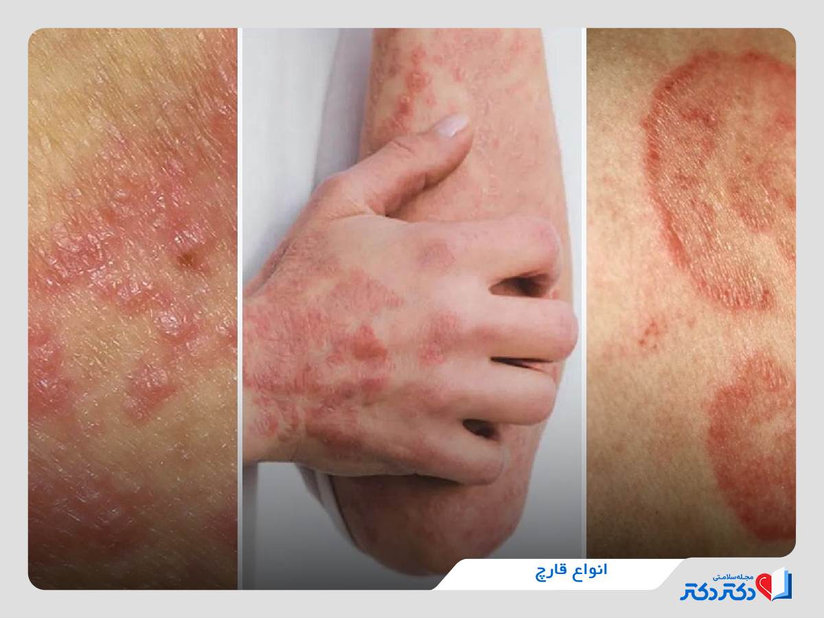 انواع قارچ و بیماری قارچ پوستی