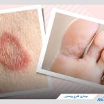 بیماری قارچ پوستی چیست؟ آیا این بیماری واگیردار است؟